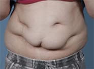 Before Image: Complex Abdominal Wall Reconstruction - front