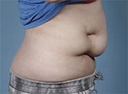Before Image: Complex Abdominal Wall Reconstruction - right-side