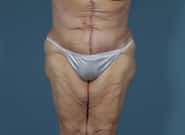 After Image: Complex Abdominal Wall Reconstruction - front