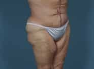 After Image: Complex Abdominal Wall Reconstruction - right-front-oblique