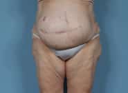 Before Image: Complex Abdominal Wall Reconstruction - front