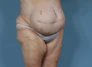 Before Image: Complex Abdominal Wall Reconstruction - right-front-oblique