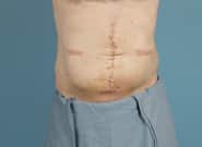 After Image: Complex Abdominal Wall Reconstruction - front