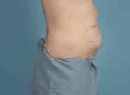 After Image: Complex Abdominal Wall Reconstruction - right-side