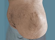 Before Image: Complex Abdominal Wall Reconstruction - front
