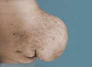Before Image: Complex Abdominal Wall Reconstruction - right-side