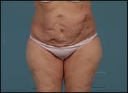 After Image: Complex Abdominal Wall Reconstruction - front
