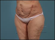 After Image: Complex Abdominal Wall Reconstruction - left-front-oblique