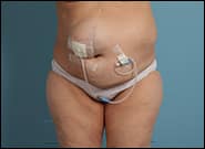 Before Image: Complex Abdominal Wall Reconstruction - front