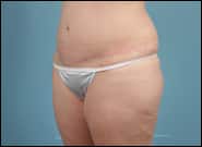 After Image: Complex Abdominal Wall Reconstruction - left-front-oblique