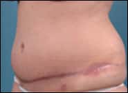 Before Image: Complex Abdominal Wall Reconstruction - left-front-oblique