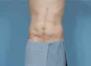 After Image: Complex Abdominal Wall Reconstruction - front