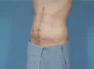 After Image: Complex Abdominal Wall Reconstruction - left-front-oblique