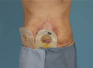 Before Image: Complex Abdominal Wall Reconstruction - front
