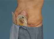 Before Image: Complex Abdominal Wall Reconstruction - left-front-oblique