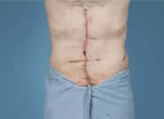 After Image: Complex Abdominal Wall Reconstruction - front