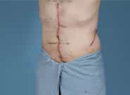 After Image: Complex Abdominal Wall Reconstruction - left-front-oblique