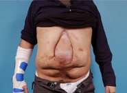 Before Image: Complex Abdominal Wall Reconstruction - front