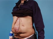 Before Image: Complex Abdominal Wall Reconstruction - left-front-oblique