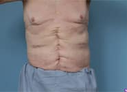 After Image: Complex Abdominal Wall Reconstruction - front