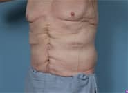 After Image: Complex Abdominal Wall Reconstruction - left-front-oblique