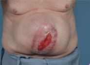 Before Image: Complex Abdominal Wall Reconstruction - front