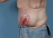 Before Image: Complex Abdominal Wall Reconstruction - left-front-oblique
