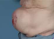 Before Image: Complex Abdominal Wall Reconstruction - left-side