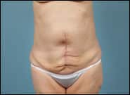 After Image: Complex Abdominal Wall Reconstruction - front