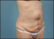 After Image: Complex Abdominal Wall Reconstruction - right-front-oblique