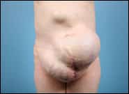 Before Image: Complex Abdominal Wall Reconstruction - front