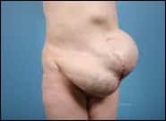 Before Image: Complex Abdominal Wall Reconstruction - right-front-oblique