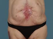 After Image: Complex Abdominal Wall Reconstruction - front