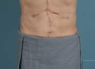 After Image: Complex Abdominal Wall Reconstruction - front