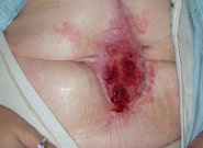 Before Image: Complex Abdominal Wall Reconstruction - front