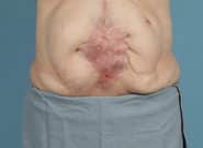 Before Image: Complex Abdominal Wall Reconstruction - front