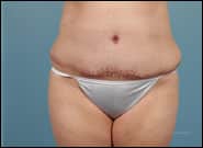 After Image: Complex Abdominal Wall Reconstruction - front