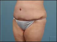 After Image: Complex Abdominal Wall Reconstruction - left-front-oblique