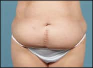 Before Image: Complex Abdominal Wall Reconstruction - front