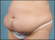 Before Image: Complex Abdominal Wall Reconstruction - left-front-oblique