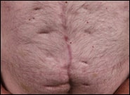 After Image: Complex Abdominal Wall Reconstruction - front