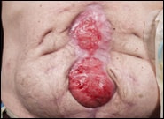 Before Image: Complex Abdominal Wall Reconstruction - front