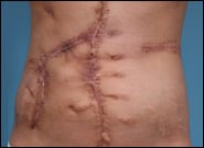 After Image: Complex Abdominal Wall Reconstruction - front