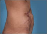 After Image: Complex Abdominal Wall Reconstruction - right-side