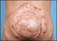 Before Image: Complex Abdominal Wall Reconstruction - front