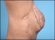 Before Image: Complex Abdominal Wall Reconstruction - right-side