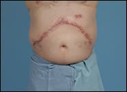 After Image: Complex Abdominal Wall Reconstruction - front