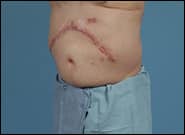 After Image: Complex Abdominal Wall Reconstruction - left-front-oblique