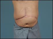 Before Image: Complex Abdominal Wall Reconstruction - front