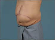 Before Image: Complex Abdominal Wall Reconstruction - left-front-oblique